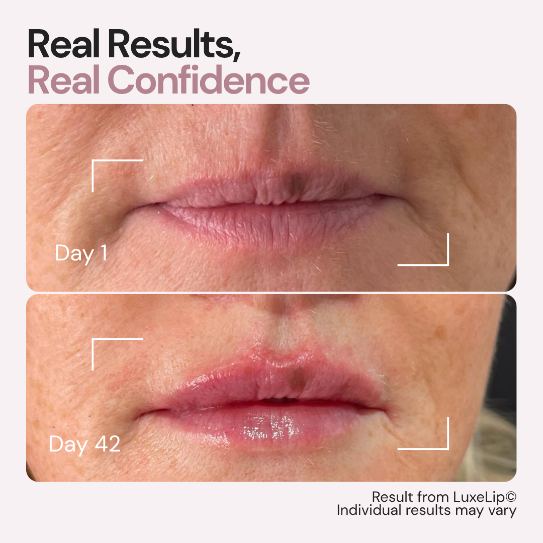 LuxeLip© Erase Lip Lines Without Injections in Just 6 min a day