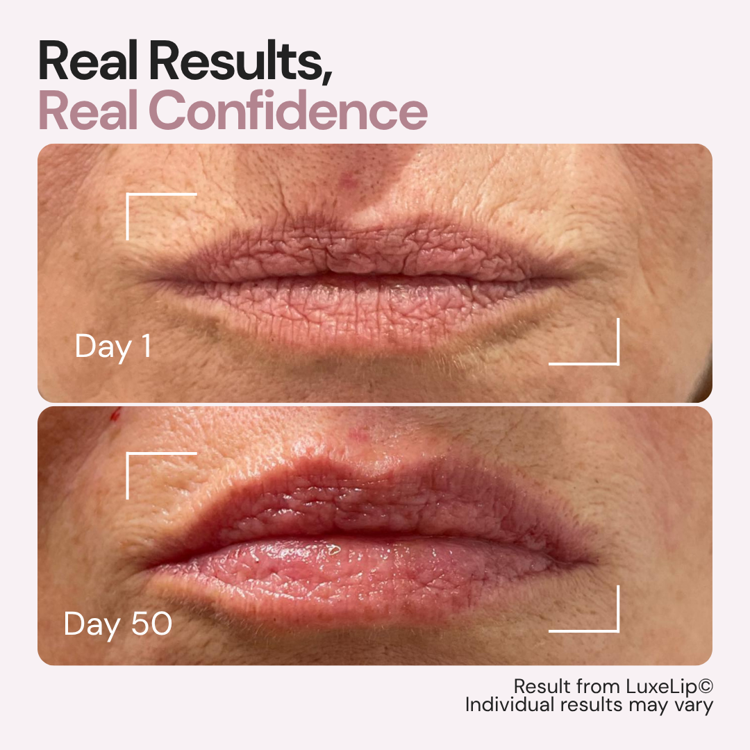 LuxeLip© Erase Lip Lines Without Injections in Just 6 min a day